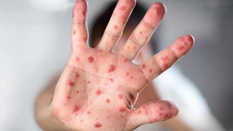 REPORTAN 172 CASOS CONFIRMADOS DE SARAMPIÓN EN MÉXICO