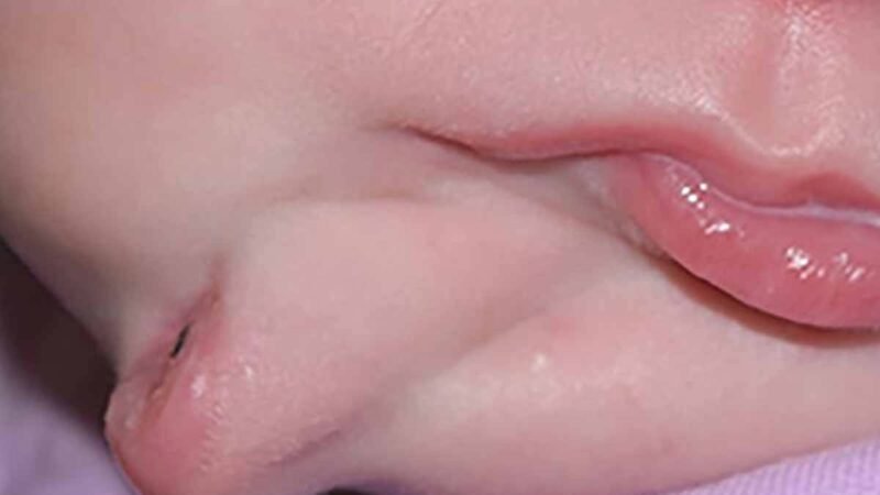 BEBÉ NACE CON EXTRAÑA CONDICIÓN; SOLO HAY 35 CASOS EN 120 AÑOS