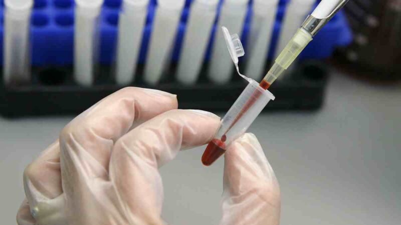 TRATAMIENTO EXPERIMENTAL DE VIH HABRÍA ELIMINADO ENFERMEDAD EN HOMBRE DE BRASIL