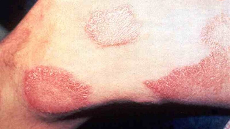 REPORTAN 89 CASOS DE LEPRA EN MÉXICO EN 2020