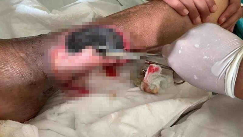 ATIENDE CLÍNICA DEL IMSS A PACIENTES CON PIE DIABÉTICO