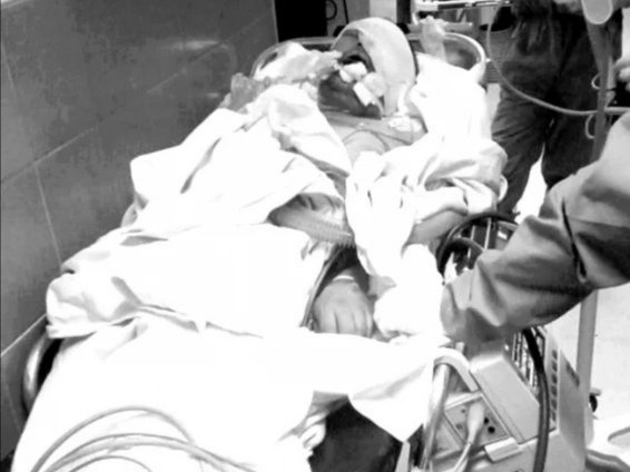 EXTIRPAN A GREGORIO TEJIDO POR SOSPECHA DE “HONGO NEGRO”; SIGUE GRAVE