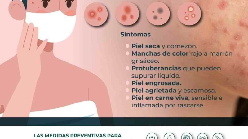 AUMENTA DERMATITIS POR TEMPORADA INVERNAL