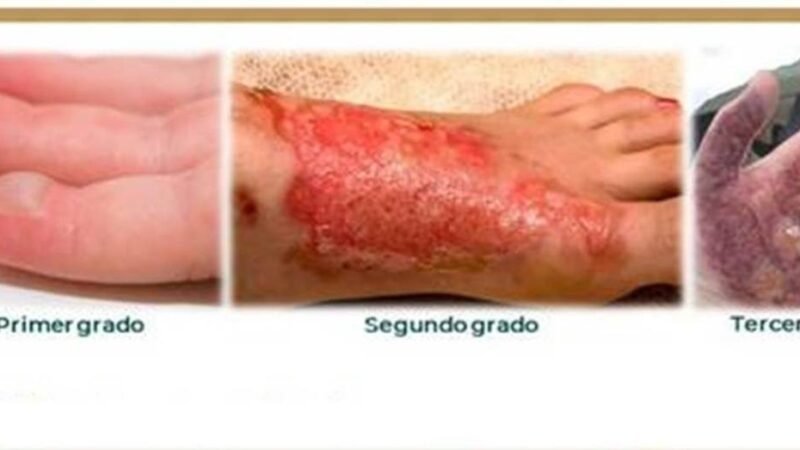 ADVIERTE IMSS VERACRUZ SUR CONSECUENCIAS DEL USO DE FUEGOS ARTIFICIALES