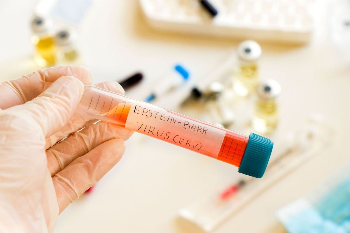 LA “ENFERMEDAD DEL BESO” PUEDE SER LA CAUSA PRINCIPAL DE LA ESCLEROSIS MÚLTIPLE