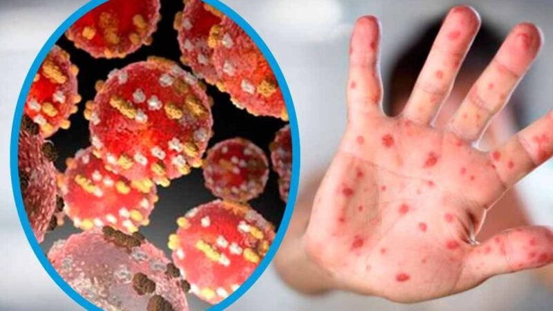 ESTADOS UNIDOS CONFIRMA 12 CASOS DE VIRUELA DEL MONO