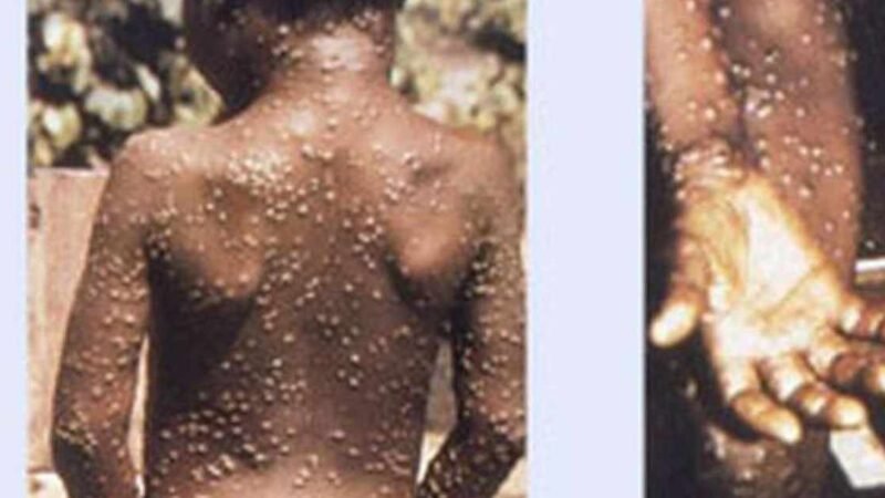 SUMAN MÁS DE 2 MIL CASOS DE VIRUELA DEL MONO EN EL MUNDO