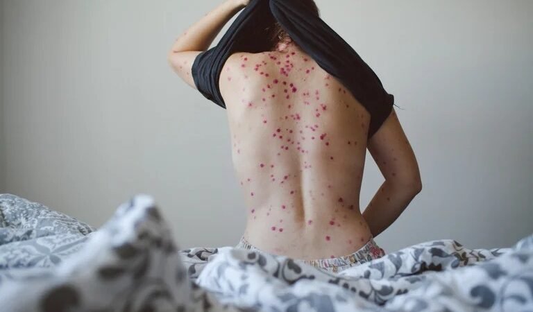 ESTADOS UNIDOS SUMA 700 CASOS DE VIRUELA DEL MONO