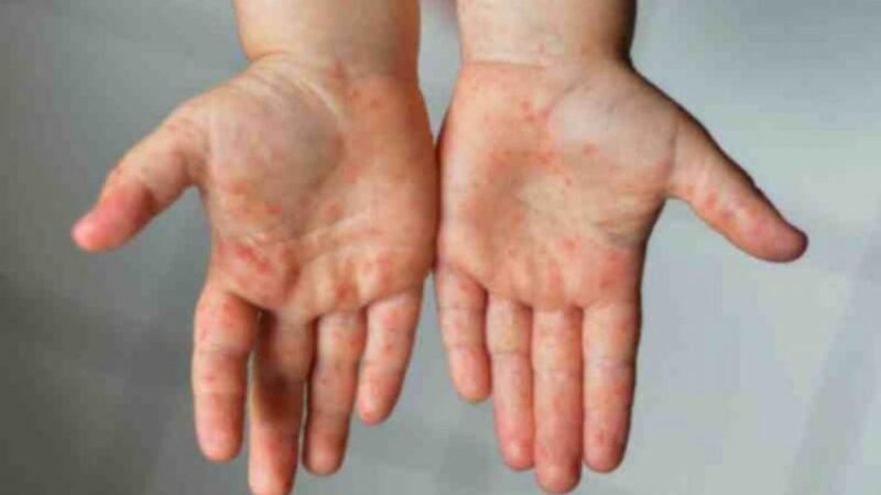 LA SECRETARÍA DE SALUD EMITE SEGUNDO AVISO EPIDEMIOLÓGICO POR LA VIRUELA DEL MONO