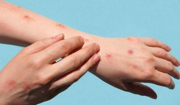 EXPERTOS AFIRMAN QUE LA VIRUELA DEL MONO EN ÁFRICA NO SE CONCENTRA EN HOMBRES HOMOSEXUALES