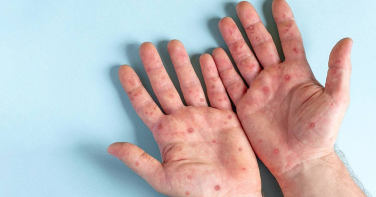 SUMAN MIL 968 CASOS DE VIRUELA SÍMICA EN MÉXICO