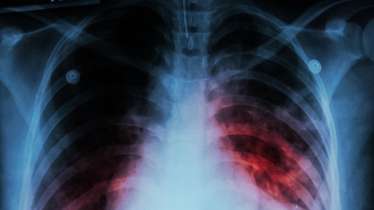 LA OMS ADVIERTE QUE LA TUBERCULOSIS VUELVE A PROPAGARSE EN EL MUNDO