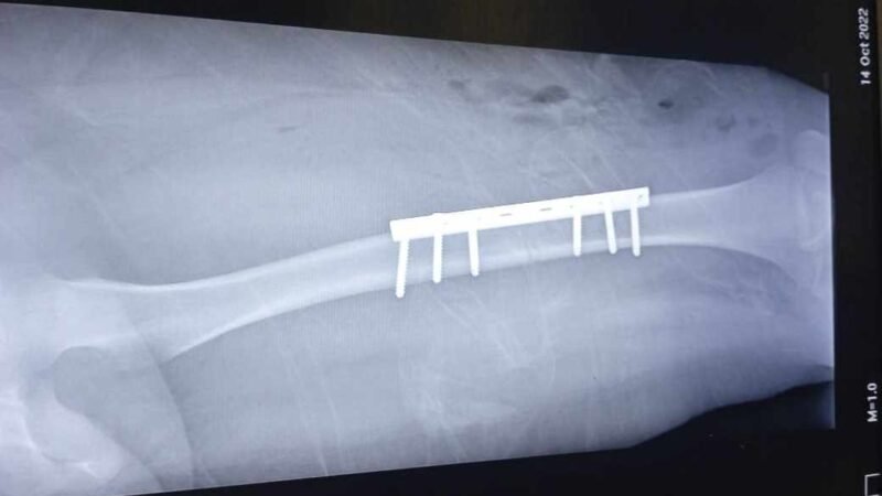 MENOR QUEDA LESIONADA DE GRAVEDAD TRAS ACCIDENTE DE MOTO