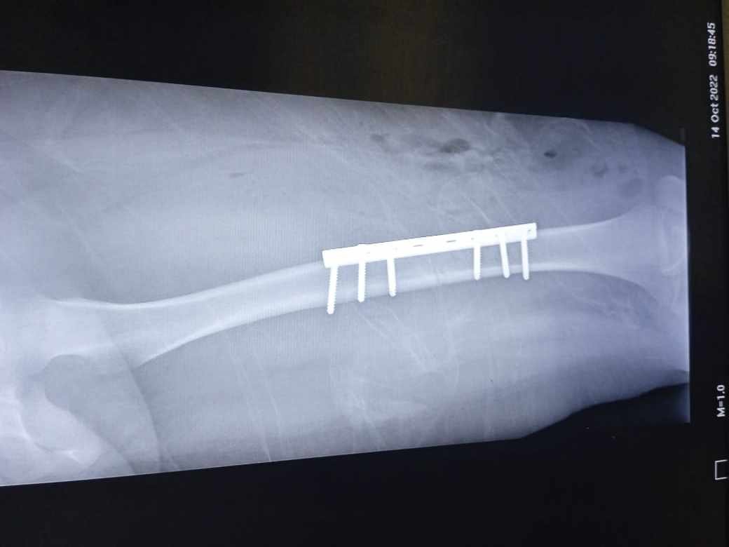 MENOR QUEDA LESIONADA DE GRAVEDAD TRAS ACCIDENTE DE MOTO