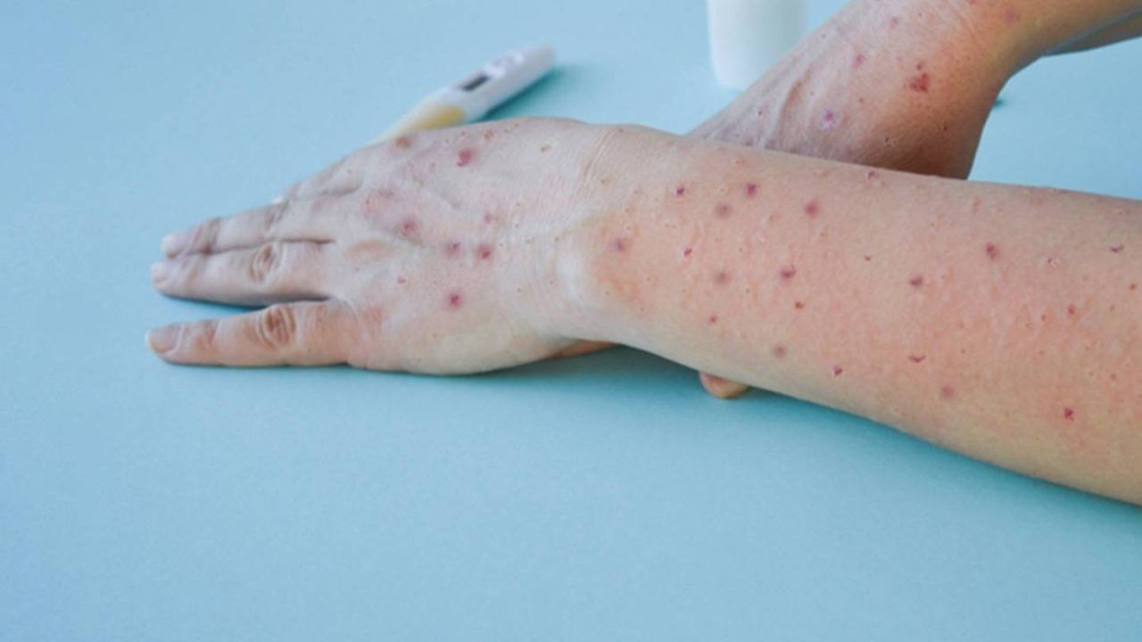 SINALOA REPORTA PRIMERA MUERTE POR VIRUELA DEL MONO