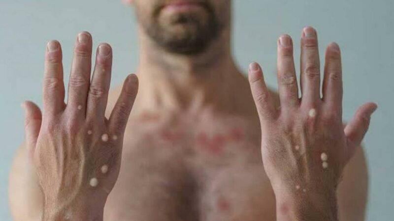 CONFIRMAN 9 CONTAGIOS MÁS DE VIRUELA SÍMICA EN MÉXICO