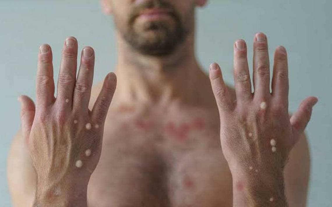 CONFIRMAN 9 CONTAGIOS MÁS DE VIRUELA SÍMICA EN MÉXICO