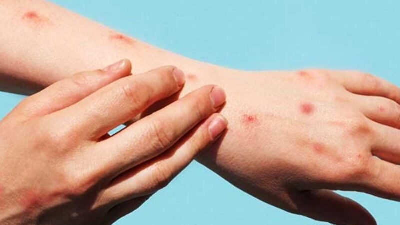 VIRUELA SÍMICA SE HA REDUCIDO 90% A NIVEL MUNDIAL