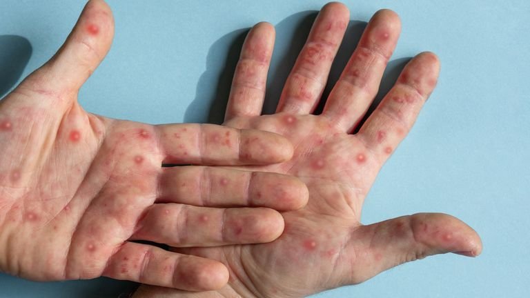 PORTUGAL REGISTRA NUEVO BROTE DE VIRUELA DE MONO