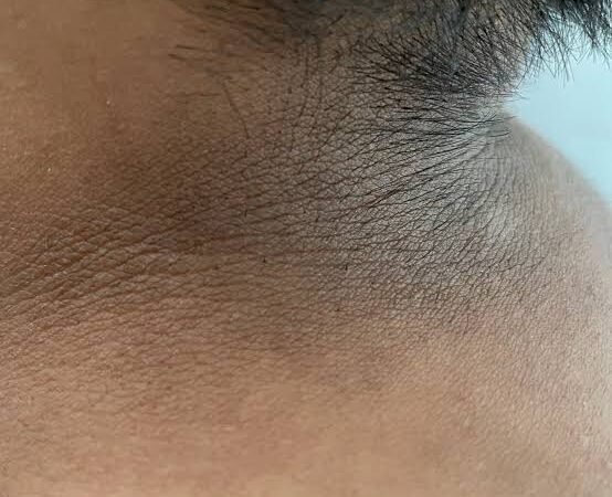 MANCHAS NEGRAS EN EL CUELLO, ALERTA DE PREDIABÉTES