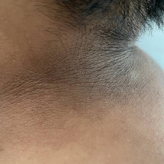 MANCHAS NEGRAS EN EL CUELLO, ALERTA DE PREDIABÉTES