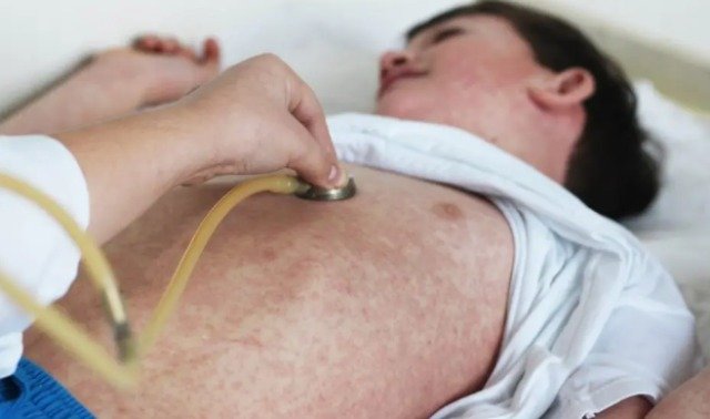 AUMENTAN CASOS DE SARAMPIÓN EN EUROPA