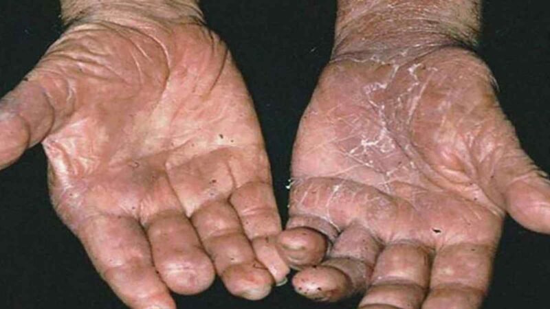 LA LEPRA AÚN NO SE HA ERRADICADO EN MÉXICO: UNAM