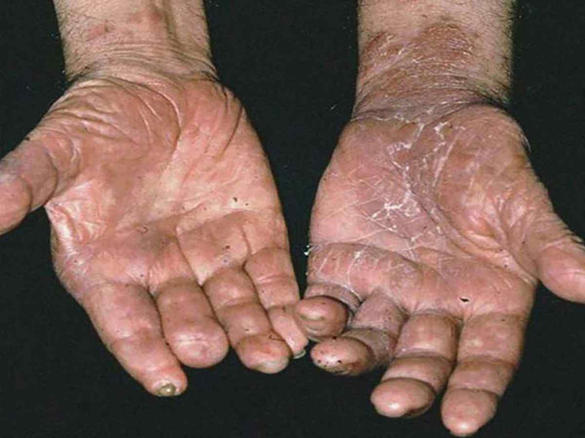 LA LEPRA AÚN NO SE HA ERRADICADO EN MÉXICO: UNAM