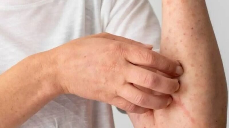 EMITE AVISO EPIDEMIOLÓGICO POR SARAMPIÓN EN EL PAÍS