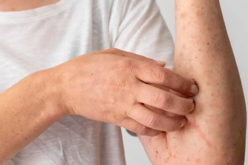 EMITE AVISO EPIDEMIOLÓGICO POR SARAMPIÓN EN EL PAÍS