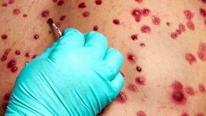 SUMAN 19 MIL CASOS DE VIRUELA DEL MONO Y 540 MUERTES EN ÁFRICA