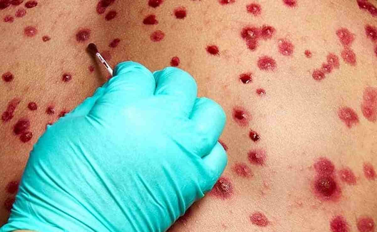 SUMAN 19 MIL CASOS DE VIRUELA DEL MONO Y 540 MUERTES EN ÁFRICA