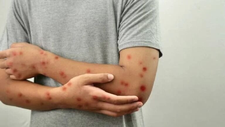 TAILANDIA CONFIRMA EL PRIMER CASO DE LA NUEVA VARIANTE DE VIRUELA