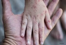 PIDEN FILTROS SANITARIOS EN LA FRONTERA SUR DE MÉXICO POR RIESGO DE VIRUELA DE MONO