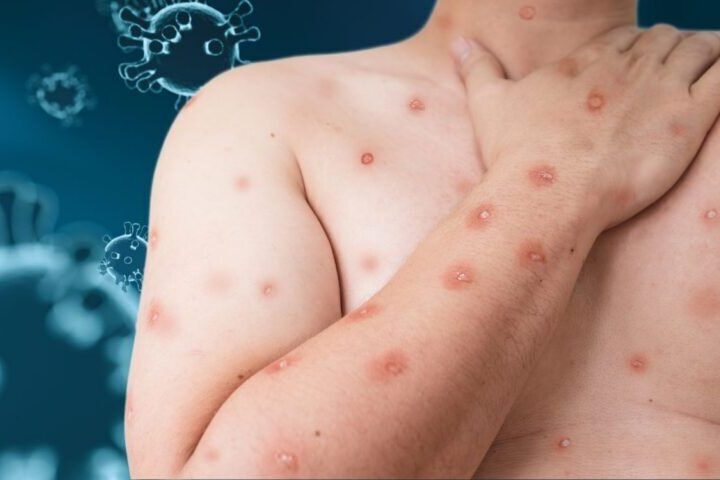 MÉXICO EN TOP 10 DE PAÍSES MÁS AFECTADOS POR MPOX