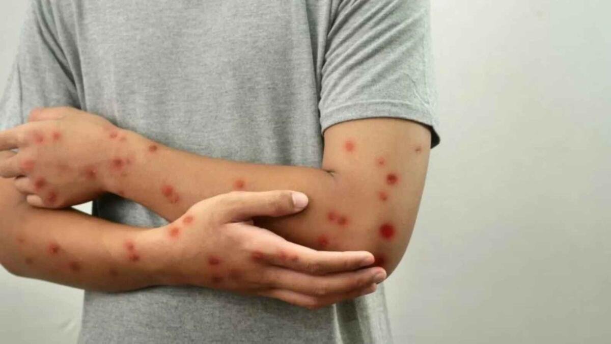 VAN 261 CASOS DE SARAMPIÓN EN CHIHUAHUA