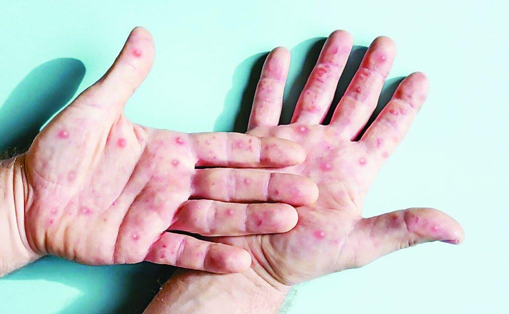 MÉXICO SUPERA CASOS DE SARAMPIÓN; CHIHUAHUA ENCABEZA LISTA