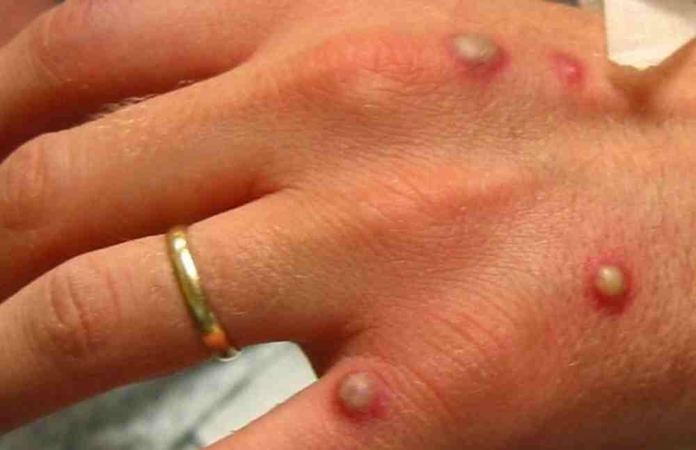 SE DISPARAN CASOS DE VIRUELA DEL MONO EN MÉXICO