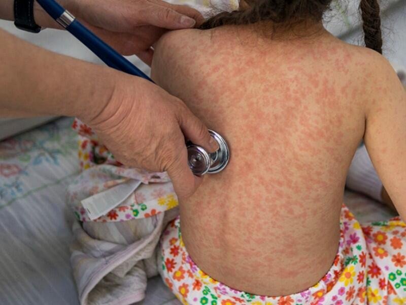 MÉXICO REBASA LOS CUATRO MIL CASOS DE SARAMPIÓN