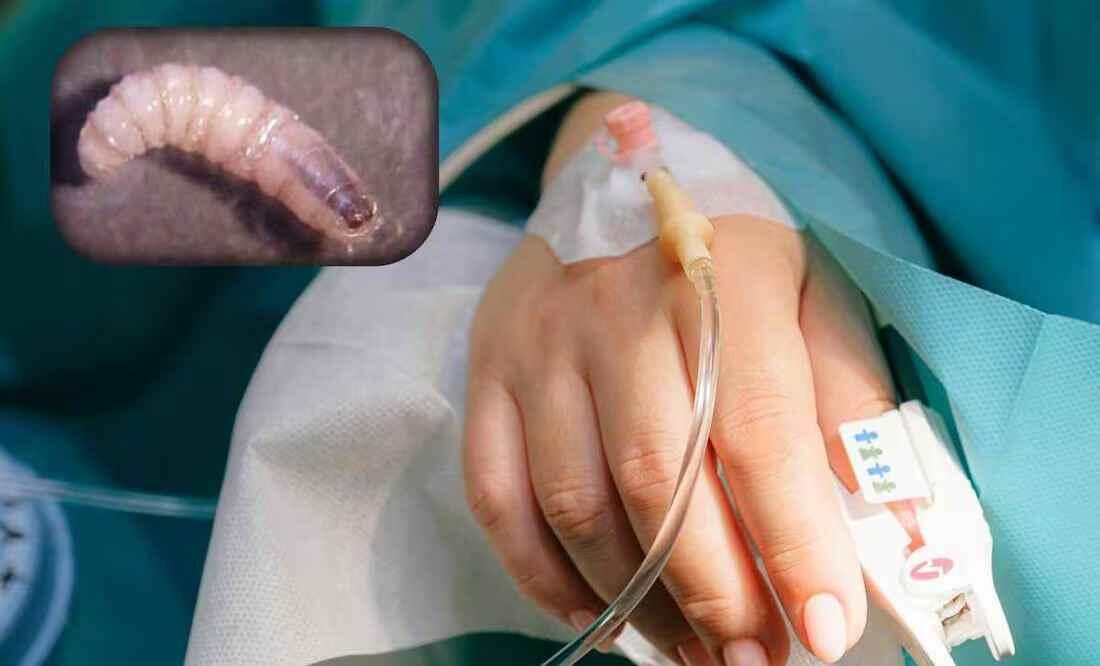 DETECTAN PERSONA INFECTADA POR GUSANO BARRENADOR EN YUCATÁN