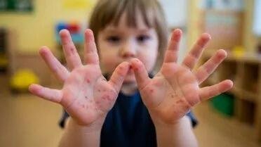 CIERRAN JARDÍN DE NIÑOS POR BROTE DE VIRUS COXSACKIE