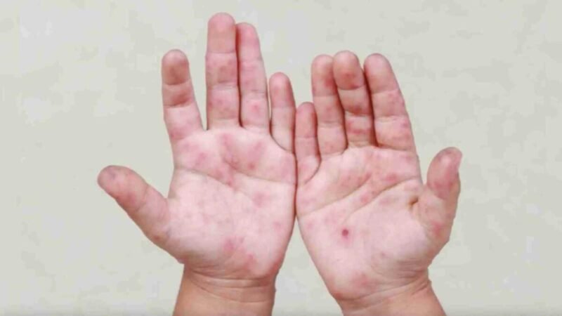 SE EXTIENDEN CASOS DE COXSACKIE EN EL PAÍS