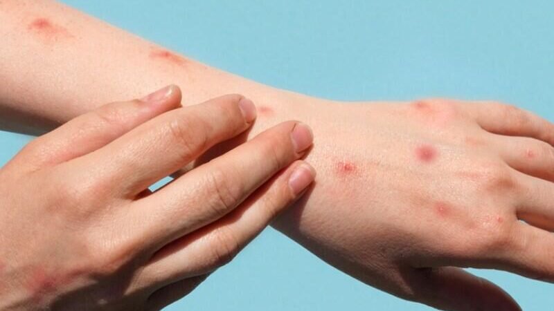 EN RIESGO, CERTIFICACIÓN CONTRA SARAMPIÓN EN MÉXICO