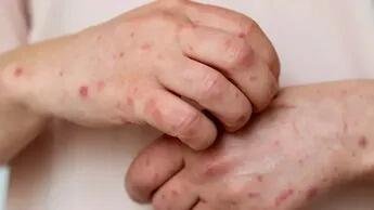 REPORTAN PRIMER CASO DE SARAMPIÓN EN PUEBLA