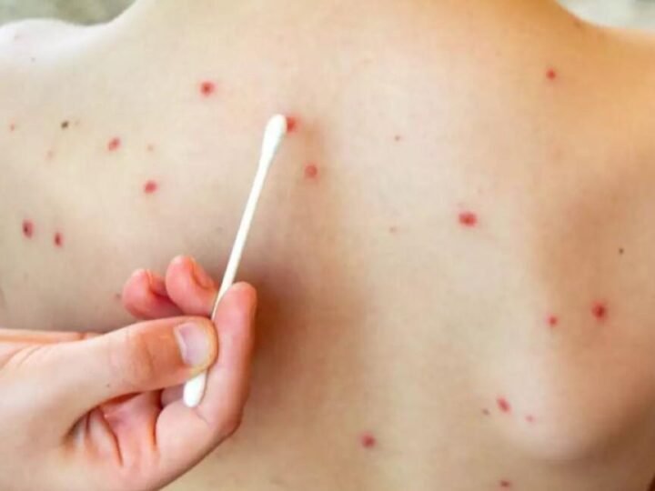 SARAMPIÓN SUPERA LOS 2 MIL CASOS EN LO QUE VA DE 2026