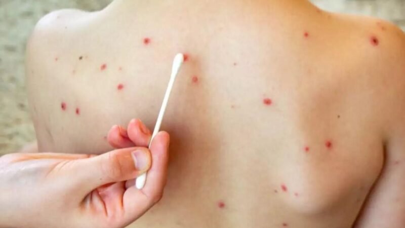 SARAMPIÓN SUPERA LOS 2 MIL CASOS EN LO QUE VA DE 2026