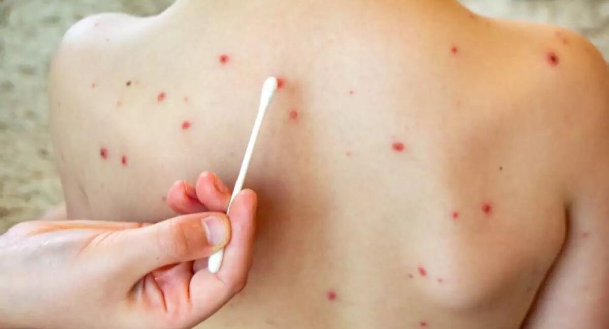 SARAMPIÓN SUPERA LOS 2 MIL CASOS EN LO QUE VA DE 2026