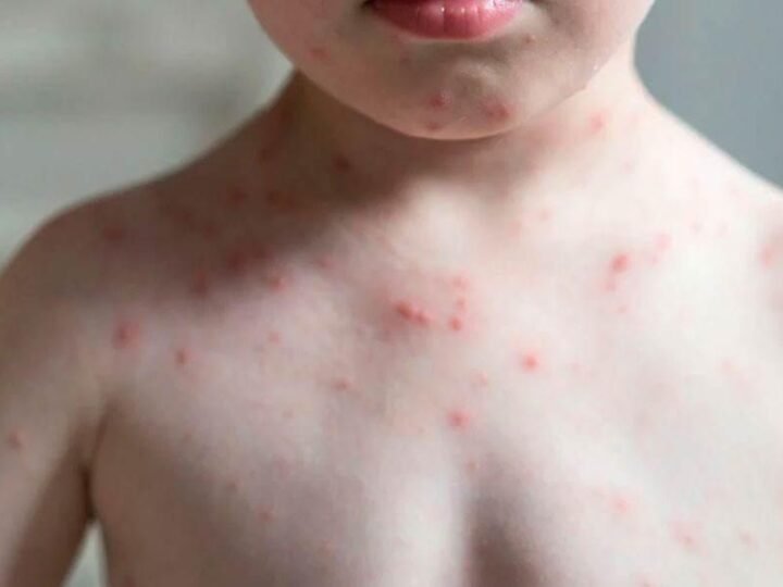 SUMAN 28 MUERTES DE SARAMPIÓN EN MÉXICO