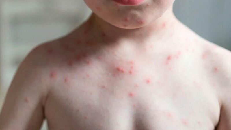 SUMAN 28 MUERTES DE SARAMPIÓN EN MÉXICO