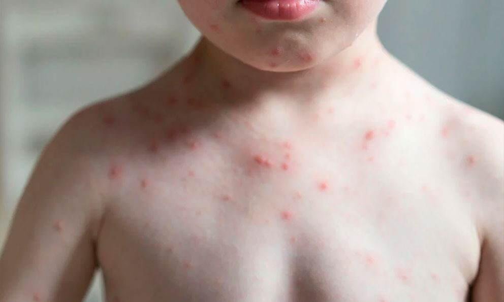 SUMAN 28 MUERTES DE SARAMPIÓN EN MÉXICO